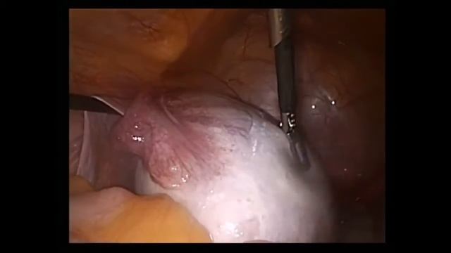 Что такое киста яичника? смотреть онлайн