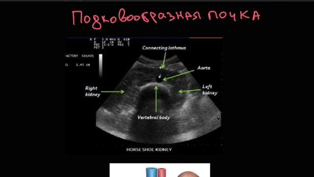 Агенезия почек. Подковообразная почка. Duplex collecting system. смотреть онлайн