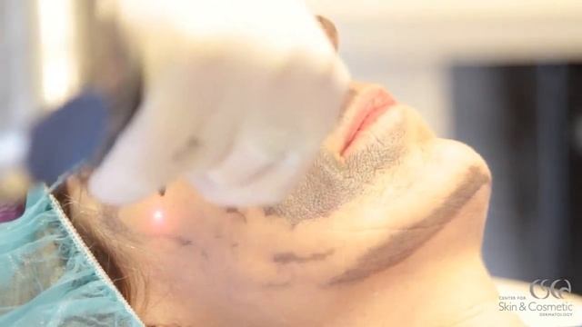 Hollywood (Spectra) Peel - Голливудский карбоновый пилинг смотреть онлайн