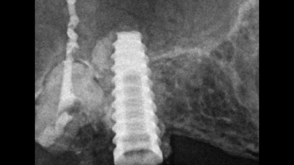 Laser Dental Clinic.Dr.Majed Kataw.internal Sinus lifting