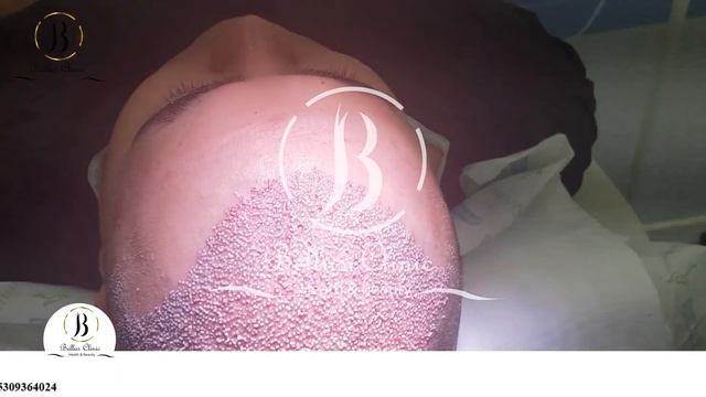 Пересадка волос на большое облысение. Результат пересадки волос Динара из Башкирии