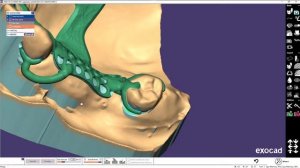 EXOCAD моделировка бюгельного протеза