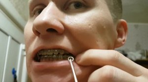 Как надеть ортодонтические тяги(резинки) на брекеты пинцетом