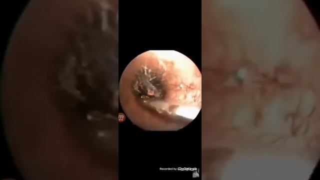 Ушные болезни. Серная пробка,инородное тело в ушном проходе смотреть онлайн