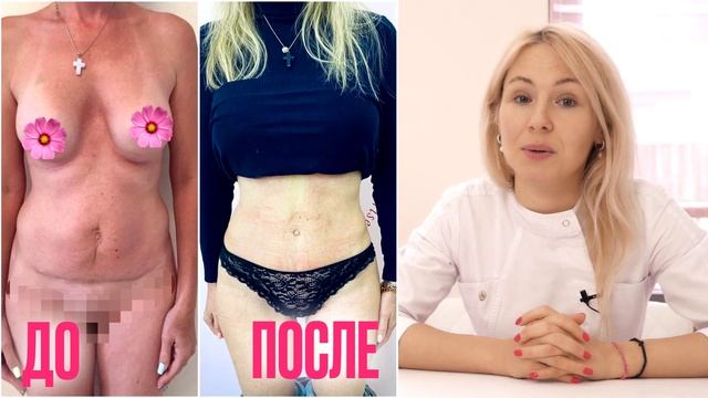 Повторная пластика, какой ждать результат? смотреть онлайн