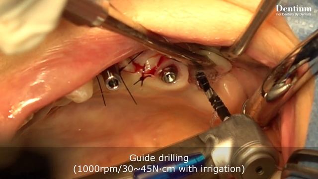 Sinus elevation : Crestal approach using DASK Simple смотреть онлайн