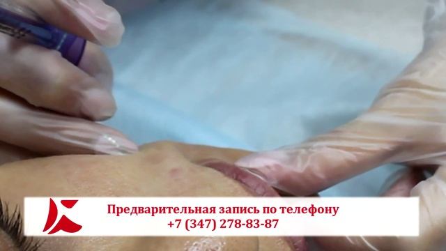 Контурная пластика носогубных складок