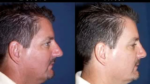 Charlotte Rhinoplasty | Dr Sean Freeman | Only Faces смотреть онлайн