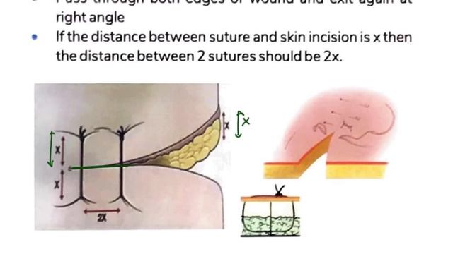 SIMPLE INTERRUPTED SUTURE || How To Suture Like A Surgeon смотреть онлайн