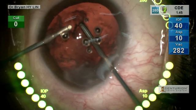 Complicated cataract surgery Using bimanual anterior vitrectomy in PCR смотреть онлайн