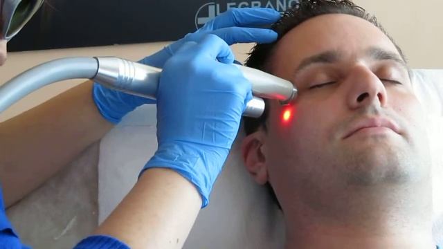 Legrano - Лазерна епилация на скули