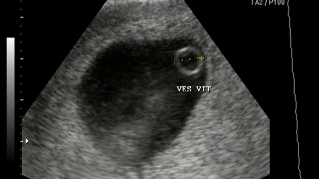 primeiro ultrason bebê de roberto e paula смотреть онлайн