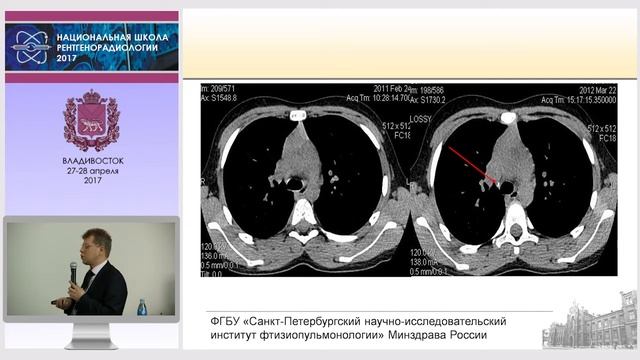 П.В. Гаврилов - Первичные формы туберкулеза у детей смотреть онлайн