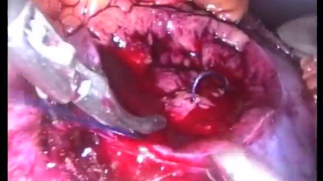 Laparoscopic partial nephrectomy for Bosniak 4 cyst. смотреть онлайн