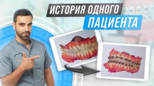 Как пациент исправил прикус  #брекеты #элайнеры