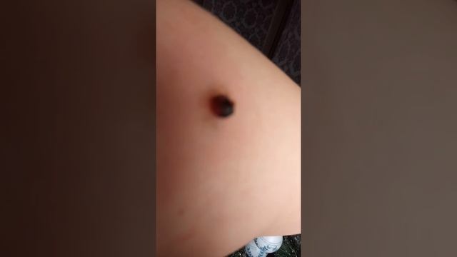 Папилломы вывожу чистотелом. смотреть онлайн