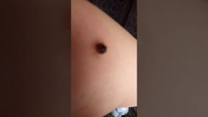 Папилломы вывожу чистотелом.