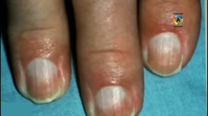 Болезни Ногтей На Ногах И Руках С Примерами На Фото. Часть 1