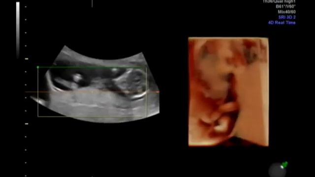 Twins ultrasonography 10 weeks смотреть онлайн