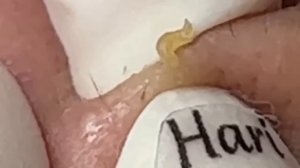 чистка пор лица от черных точек #822