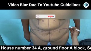 Abdominoplasty Surgery | Marking and Planning of Female Tummy Tuck with Liposuction | ‪09711707831‬