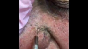 НОВОЕ ВИДЕО 2021  Прыщи давить залипательно