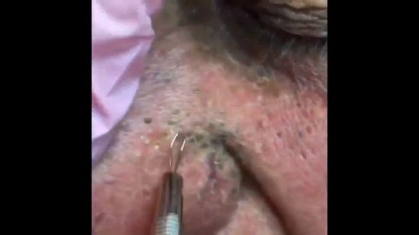 НОВОЕ ВИДЕО 2021  Прыщи давить залипательно