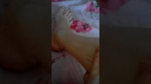 Разрыв ахиллового сухожилия.ортез(разрыв ахилла)