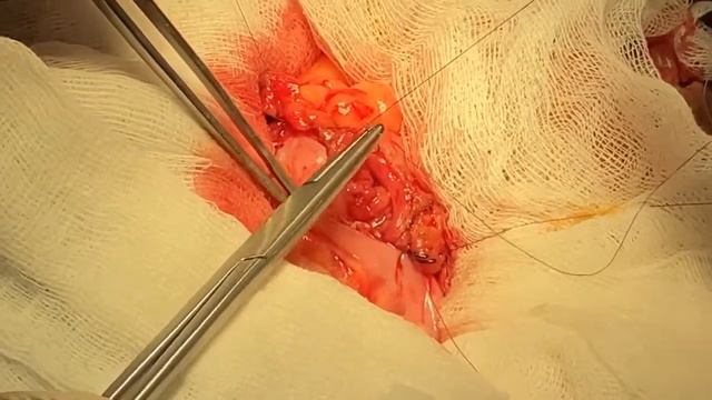 Kolo-kolo anastomozun qoyulması/Colo-Colo anastomosis смотреть онлайн