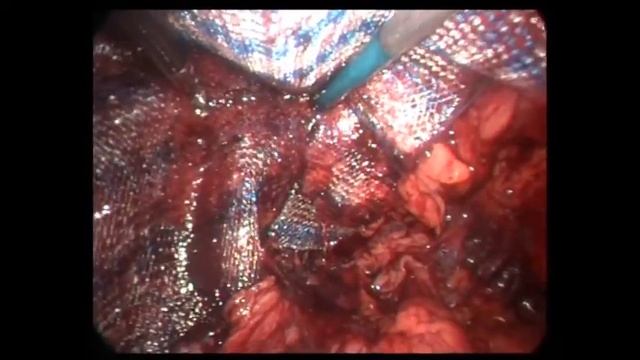 еТЕР, как выглядит сетка 20 х 15см в паховой зоне. смотреть онлайн