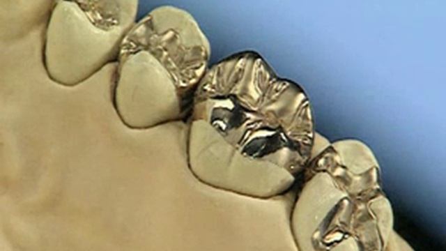 Золотые вкладки_armdent.am смотреть онлайн