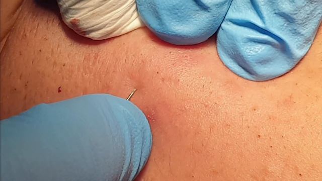 BLACKHEADS EXTRACTIONS on Happy :)- #8 смотреть онлайн