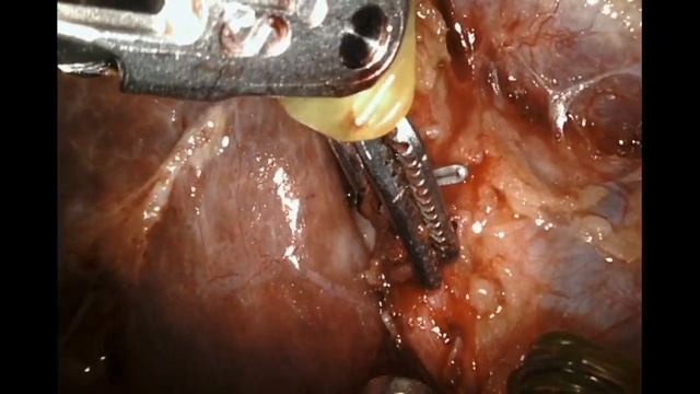 Gallbladder cancer lymph nodes and liver resection for incidental cancer, robotic. смотреть онлайн