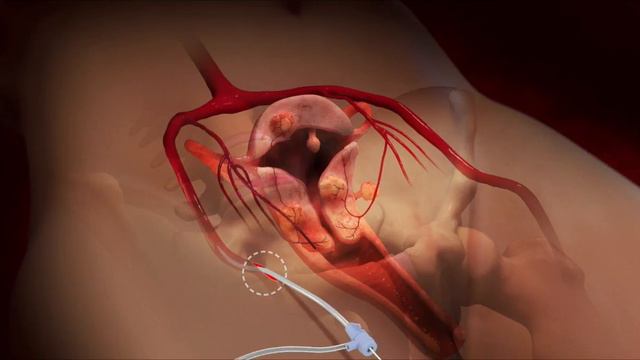 Dr. Harris Narrates A 3-D Animation of a Uterine Fibroid Embolization (UFE) смотреть онлайн