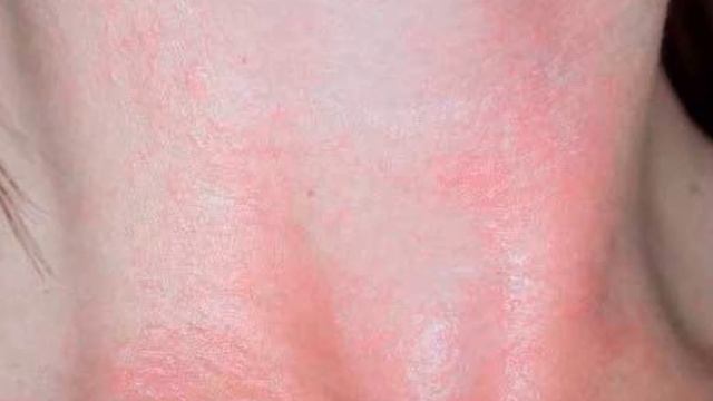 Аллергия на солнце смотреть онлайн