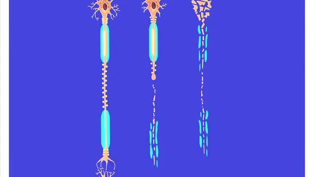 Pathogenesis of Neurological Disability in Multiple Sclerosis смотреть онлайн