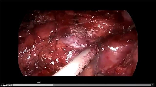 Gallbladder Cancer Updates Operative Management Including MIS смотреть онлайн