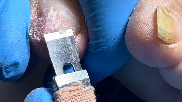 Curly nails, heavily infected by onychomycosis【Pedicure Master Lin Jun】 смотреть онлайн