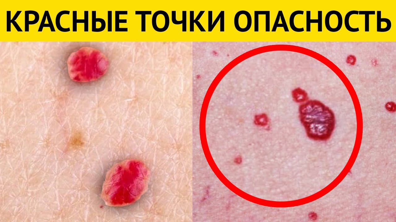 Чем Опасны КРАСНЫЕ ТОЧКИ на теле? Почему появляются красные точки? смотреть онлайн