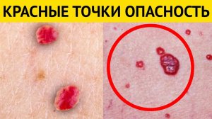 Чем Опасны КРАСНЫЕ ТОЧКИ на теле? Почему появляются красные точки?