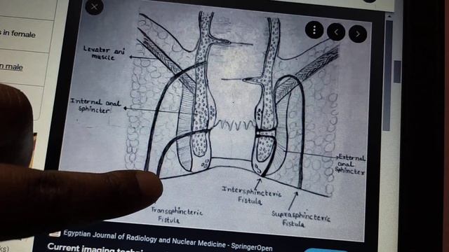 GIT SURGERY lecture 60 FISTULA IN ANO with main concept in easy way смотреть онлайн