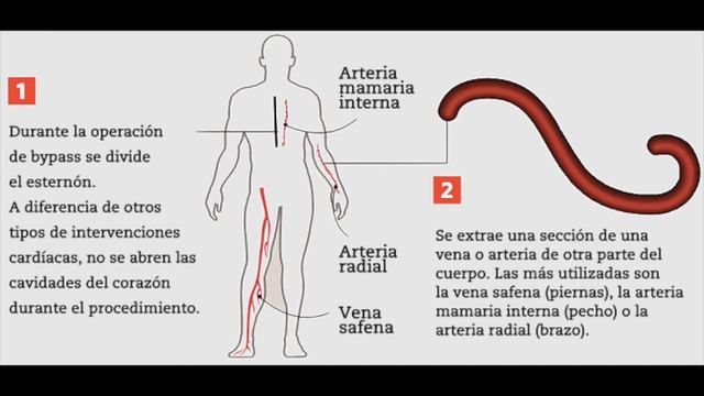 Revascularización coronaria смотреть онлайн