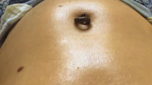 bug in my belly button