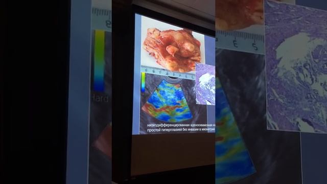 Гажонова В.Е. СЭГ и патология эндометрия. смотреть онлайн