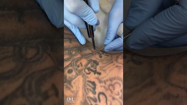 Лазерное удаление папиллом! смотреть онлайн