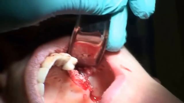 Sinus lift with PRGF смотреть онлайн