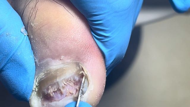 Treat onychomycosis with a special method to make hard nails soft【Pedicure Master Lin Jun】 смотреть онлайн