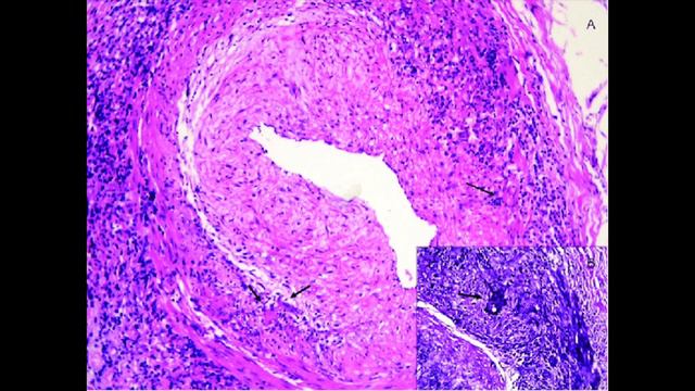 Giant cell Arteritis and Takayasu arteritis (Large Vessel Vasculitis) - signs, pathophysiology смотреть онлайн