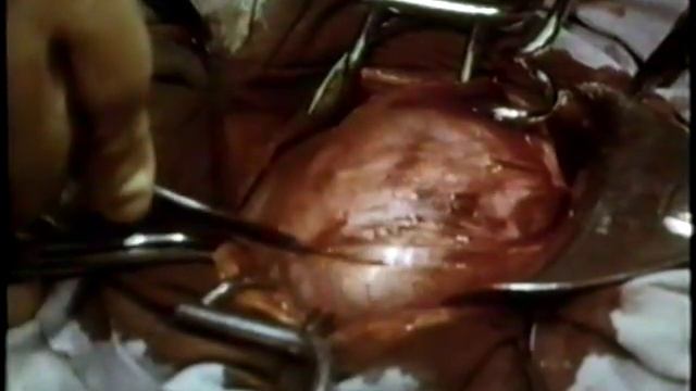 Миома матки, МИОМЭКТОМИЯ © Conservative myomectomy смотреть онлайн