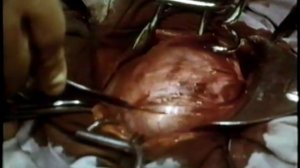 Миома матки, МИОМЭКТОМИЯ © Conservative myomectomy